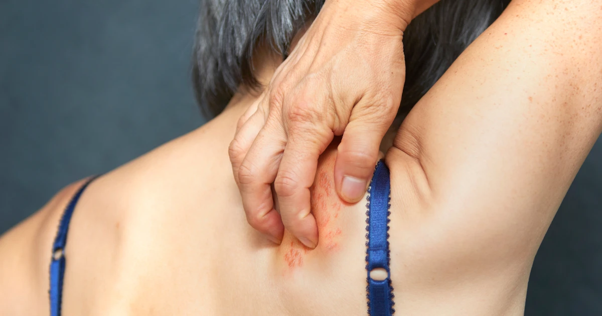 Shingles vaccine may also offer protection against dementia, studies increasingly show – NBC News