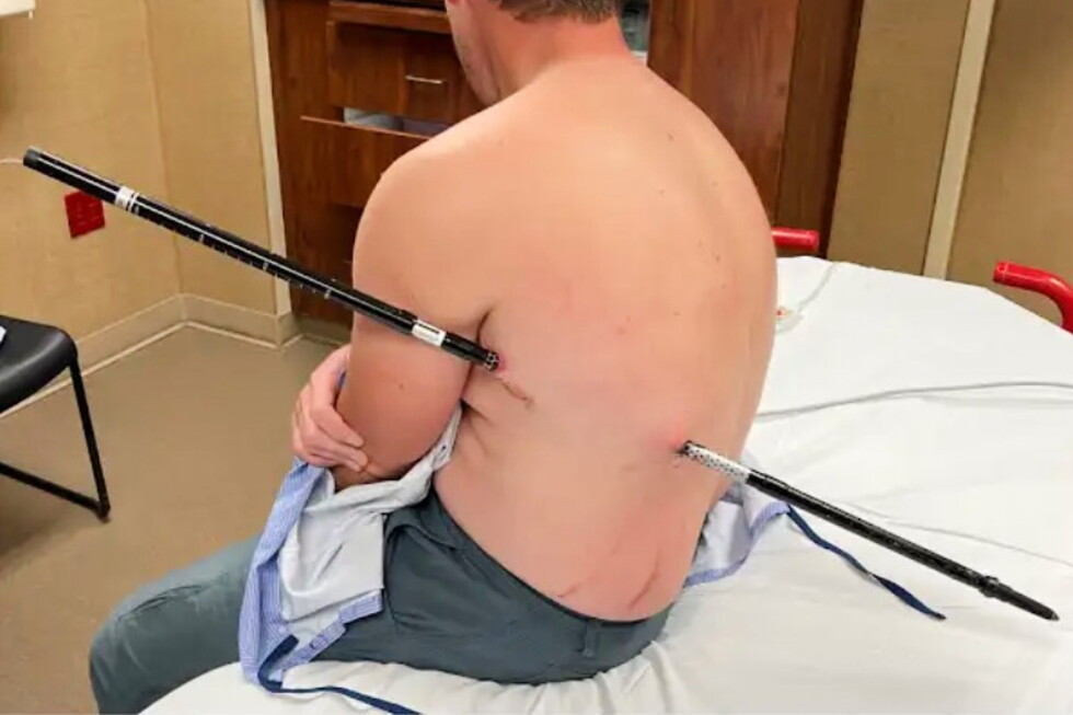 Montana man hikes out of the mountains to get help after he was impaled by a trekking pole – AP News