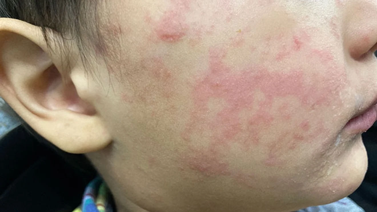 NCDHHS: Hendersonville gas station, Asheville hotel identified as measles exposure sites – WLOS