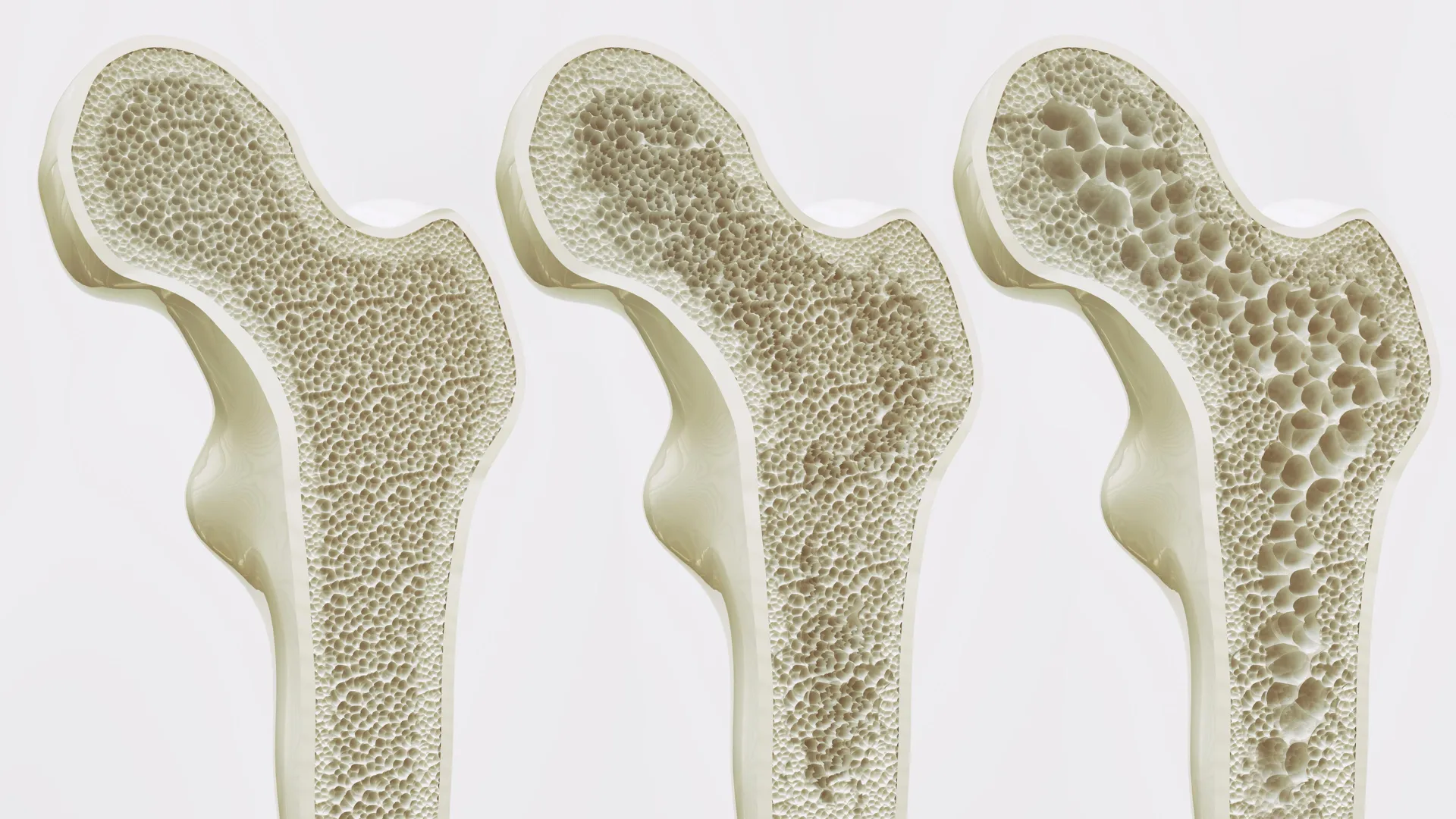Millions take calcium and vitamin D for bone health. A major review finds little benefit – ScienceDaily