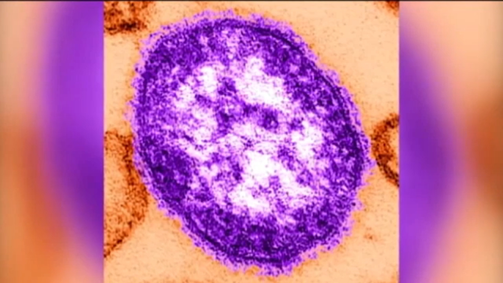 Phila. health officials warn of possible measles exposure at Philadelphia International Airport – 6abc Philadelphia